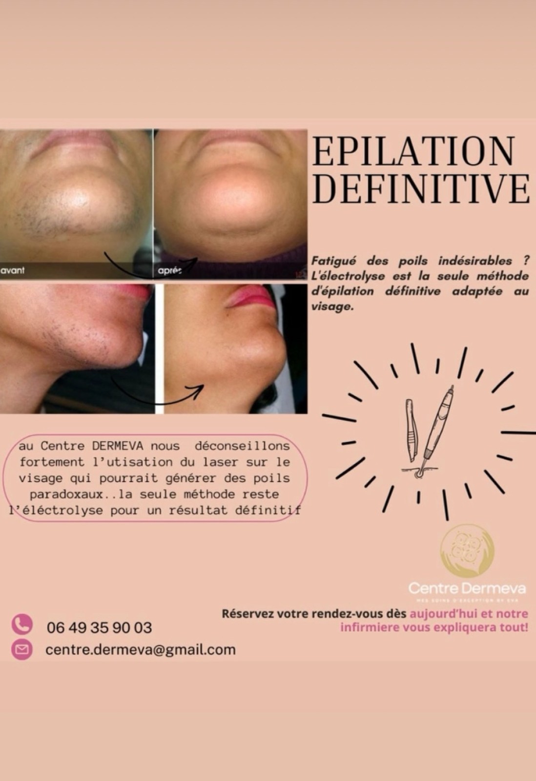 Epilation laser accompagné par un médecin près de Saint-Jean-de-Védas dans l'Hérault (34)