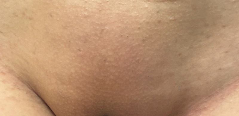 Épilation laser du maillot à Montpellier | Prix attractifs & expertise – Dermeva