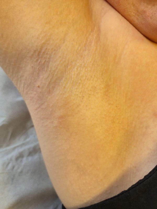 Epilation définitive laser  maillot  a 85 € proche de Clapiers à Montpellier