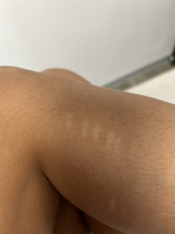 Les dangers de l’épilation laser à domicile: Epilation Laser à Montpellier