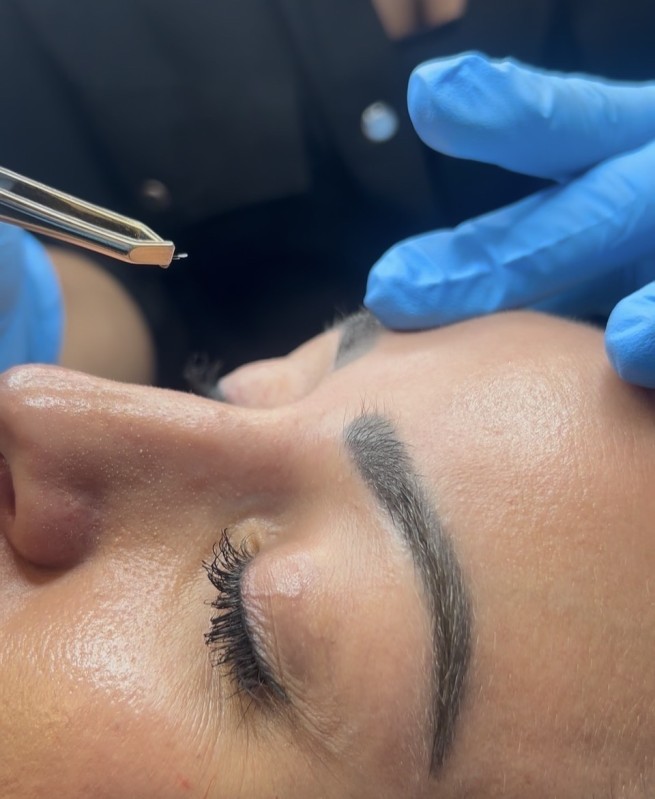 l’électrolyse est la seule méthode efficace et définitive pour vos poils du visage