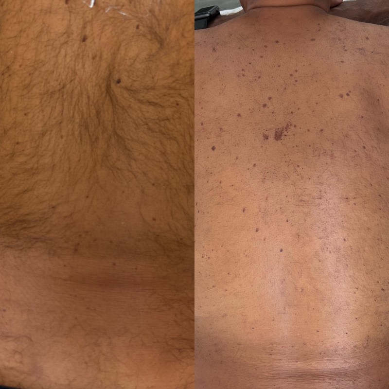  Épilation laser du dos pré de Nîmes au Centre Dermeva