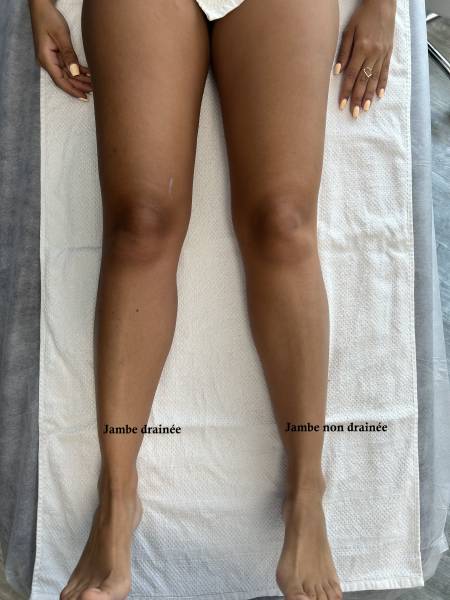 Drainage lymphatique Rénata Franca pour jambe et ventre à Montpellier