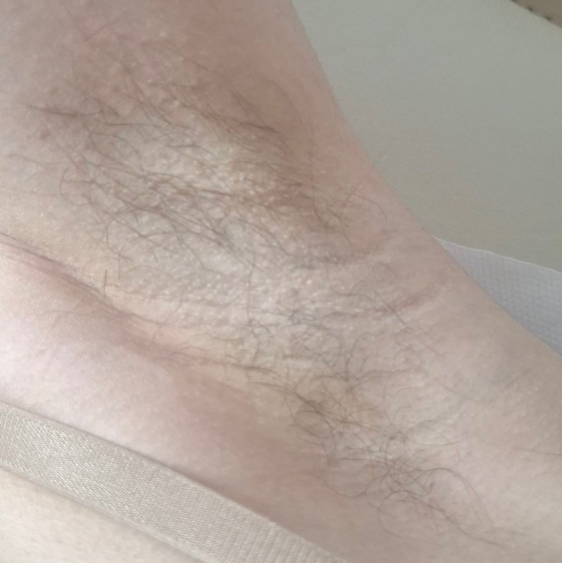 des aisselles impeccables pour cet été ?c’est maintenant !