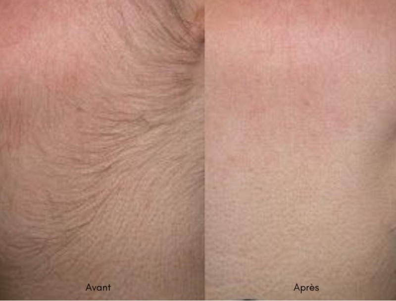  L’électrolyse,  vous assure un résultat définitif chez  Dermeva à Montpellier 