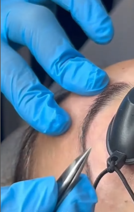 Laser électrolyse pour le visage à Montpellier