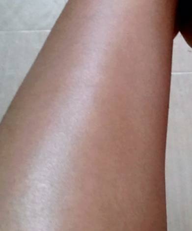 Epilation laser définitives des jambes pour femmes à Montpellier