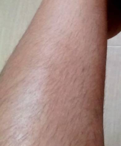 Epilation laser définitives des jambes pour femmes à Montpellier