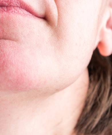 Epilation définitive laser du menton par une professionnelle à Montpellier