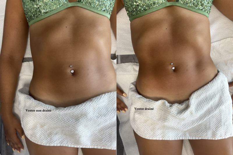 Drainage lymphatique Rénata Franca pour jambe et ventre à Montpellier